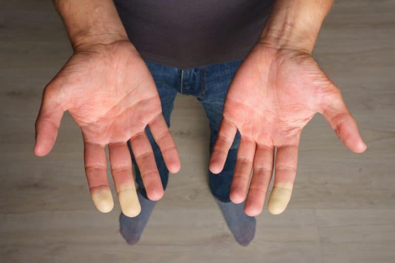 syndrome de raynaud traitement naturel